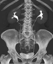 Renal Cell Carcinoma - CTisus CT Scan