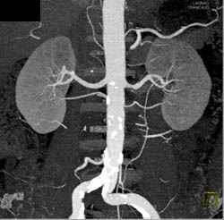 Multiple Renal Arteries to Each Kidney for Renal Donor - CTisus CT Scan