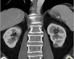 1 Cm Renal Cell Carcinoma - CTisus CT Scan