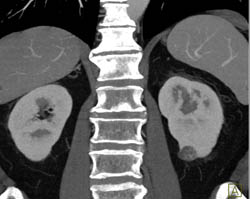 1 Cm Renal Cell Carcinoma - CTisus CT Scan