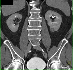 1 Cm Renal Cell Carcinoma - CTisus CT Scan