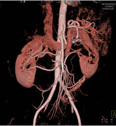 Multiple Renal Arteries - CTisus CT Scan