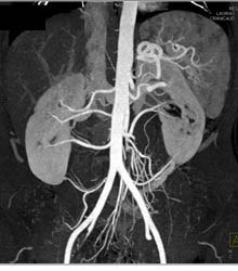 Multiple Renal Arteries - CTisus CT Scan