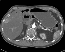 1 Cm Renal Cell Carcinoma - CTisus CT Scan