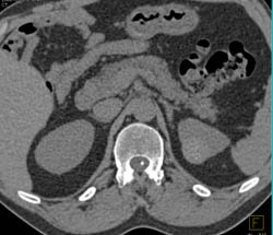 High Density Renal Cyst - CTisus CT Scan