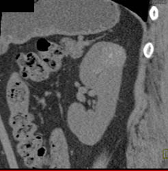 High Density Renal Cyst - CTisus CT Scan