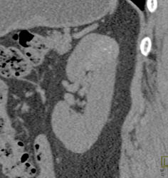 High Density Renal Cyst - CTisus CT Scan