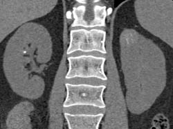 High Density Renal Cyst - CTisus CT Scan