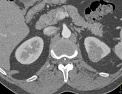 High Density Renal Cyst - CTisus CT Scan