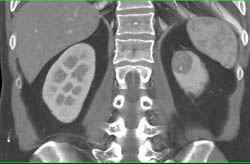 High Density Renal Cyst - CTisus CT Scan