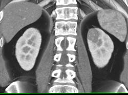 High Density Renal Cyst - CTisus CT Scan