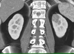 High Density Renal Cyst - CTisus CT Scan