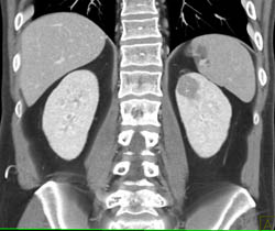 High Density Renal Cyst - CTisus CT Scan