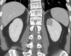 High Density Renal Cyst - CTisus CT Scan