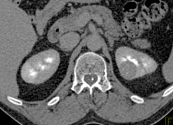 High Density Renal Cyst - CTisus CT Scan