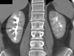 High Density Renal Cyst - CTisus CT Scan