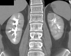 High Density Renal Cyst - CTisus CT Scan