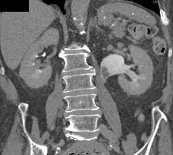 Transitional Cell Carcinoma - CTisus CT Scan