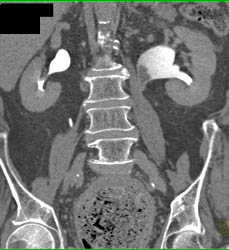 Transitional Cell Carcinoma - CTisus CT Scan