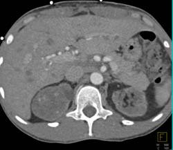 Renal Cell Carcinoma in An Atrophic Kidney - CTisus CT Scan