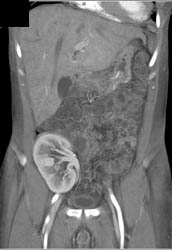 Pelvic Transplant Kidney - CTisus CT Scan