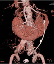 Horseshoe Kidney With Stent - CTisus CT Scan