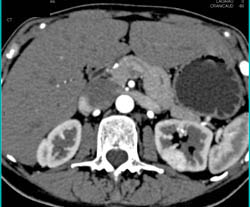 Subtle 2cm Renal Cell Carcinoma- See Sequence - CTisus CT Scan