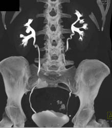 Vascular Renal Cell Carcinoma - CTisus CT Scan