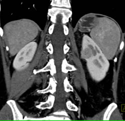 Vascular Renal Cell Carcinoma - CTisus CT Scan