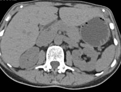 Subtle 2cm Renal Cell Carcinoma - CTisus CT Scan