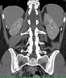 Vascular Renal Cell Carcinoma - CTisus CT Scan