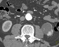 Renal Cell Carcinoma Near Cyst - CTisus CT Scan