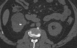 Cystic Renal Cell Carcinoma - CTisus CT Scan