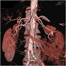 Fibromuscular Dysplasia (FMD) of Left Renal Artery - CTisus CT Scan