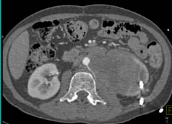 Lymphoma Involves Bone, Kidney, and Paraspinal Muscles - CTisus CT Scan