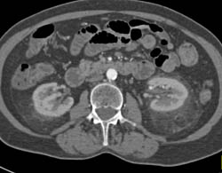 Ehlers-Danlos With Increased Density in Perirenal Space - CTisus CT Scan