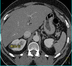 Renal Cell Carcinoma Lower Pole Left Kidney - CTisus CT Scan