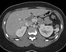 Unusual Collaterals Around Left Kidney With Collateral to Left Renal Vein and Drain Into the Pelvis - CTisus CT Scan