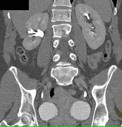 Ct Urogram With Scarring Lower Pole Right Kidney - CTisus CT Scan