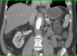 Left Nephrectomy With Metastases to the Pancreas- Vascular Metastases - CTisus CT Scan