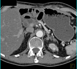 1 Cm Vascular Tumor Upper Pole Left Kidney - CTisus CT Scan