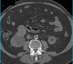 Right Parapelvic Cysts and Renal Cell Carcinoma - CTisus CT Scan