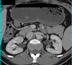 Normal CT Urogram - CTisus CT Scan