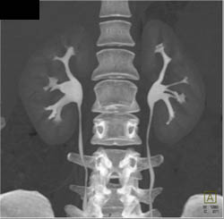 Normal CT Urogram - CTisus CT Scan