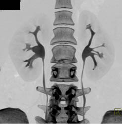 Normal CT Urogram - CTisus CT Scan