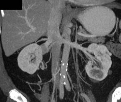 Renal Cell Carcinoma With Clot in Right Renal Vein - CTisus CT Scan