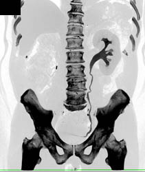 Right Nephrectomy With Normal Left Kidney - CTisus CT Scan