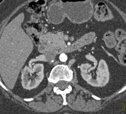 6 Mm Renal Cell Carcinoma as Incidental Finding - CTisus CT Scan