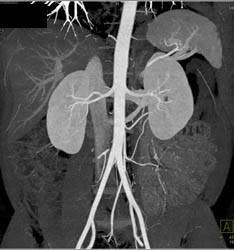 CTA of Renal Arteries Shows 2 Left Renal Arteries - CTisus CT Scan