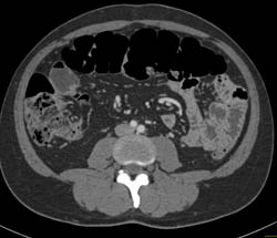 Mesenteric Nodes in Renal Cell Carcinoma - CTisus CT Scan